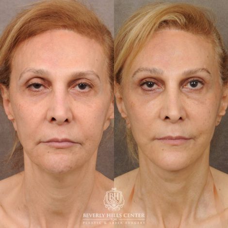 Beverly Hills Center Female Patient Before and After AuraLyft, Upper Blephatorplasty, Ptosis Repair