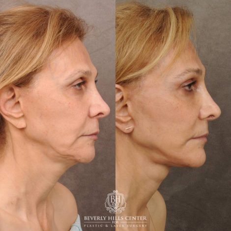 Beverly Hills Center Female Patient Before and After AuraLyft, Upper Blephatorplasty, Ptosis Repair