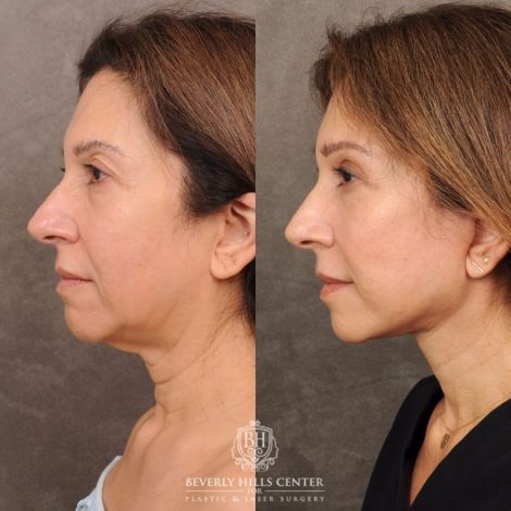Beverly Hills Center Female Patient Before and After Auralyft, Brow Lift, Upper Blepharoplasty, CUPID LIFT® Corner Lift