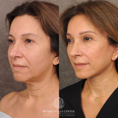 Beverly Hills Center Female Patient Before and After Auralyft, Brow Lift, Upper Blepharoplasty, CUPID LIFT® Corner Lift