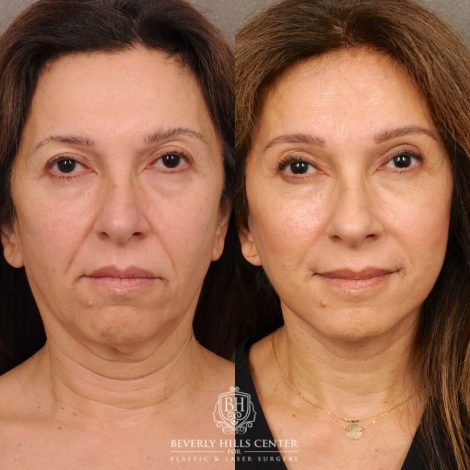 Beverly Hills Center Female Patient Before and After Auralyft, Brow Lift, Upper Blepharoplasty, CUPID LIFT® Corner Lift