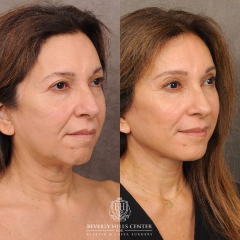 Beverly Hills Center Female Patient Before and After Auralyft, Brow Lift, Upper Blepharoplasty, CUPID LIFT® Corner Lift
