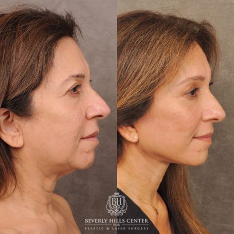 Beverly Hills Center Female Patient Before and After Auralyft, Brow Lift, Upper Blepharoplasty, CUPID LIFT® Corner Lift