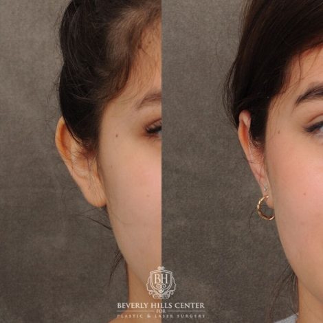 Beverly Hills Center Female Patient Before and After Otoplasty
