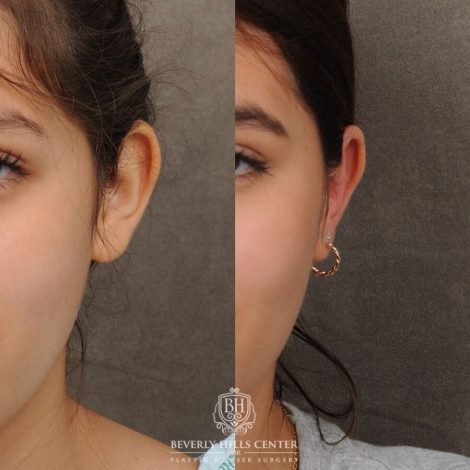 Beverly Hills Center Female Patient Before and After Otoplasty