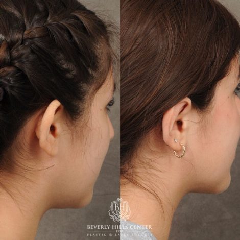 Beverly Hills Center Female Patient Before and After Otoplasty