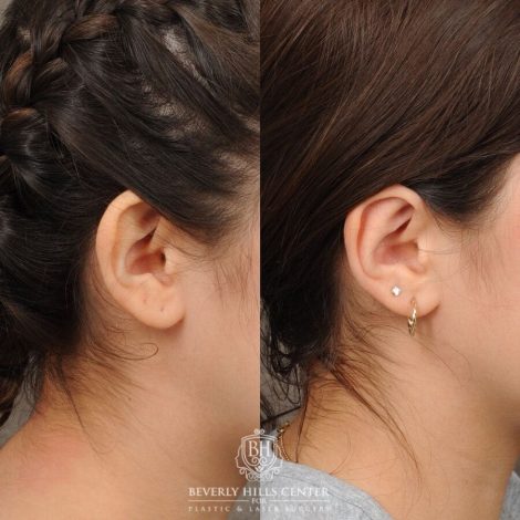 Beverly Hills Center Female Patient Before and After Otoplasty