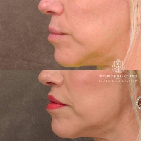 Beverly Hills Center Female Patient Before and After CUPID LIFT® Lip Lift