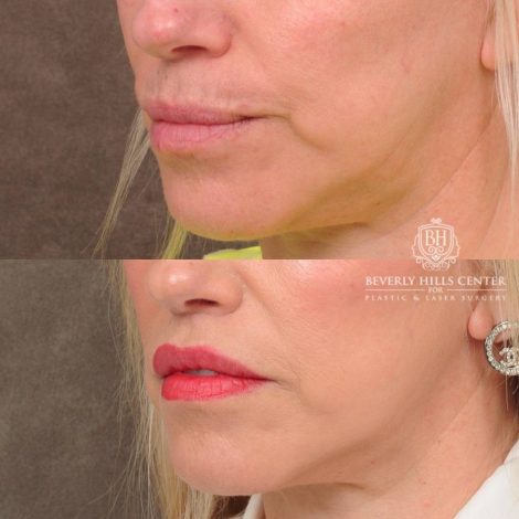 Beverly Hills Center Female Patient Before and After CUPID LIFT® Lip Lift