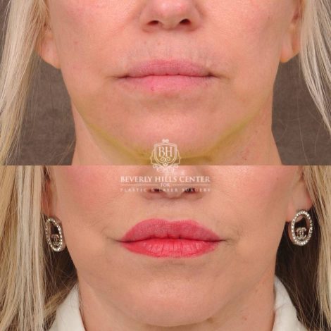 Beverly Hills Center Female Patient Before and After CUPID LIFT® Lip Lift