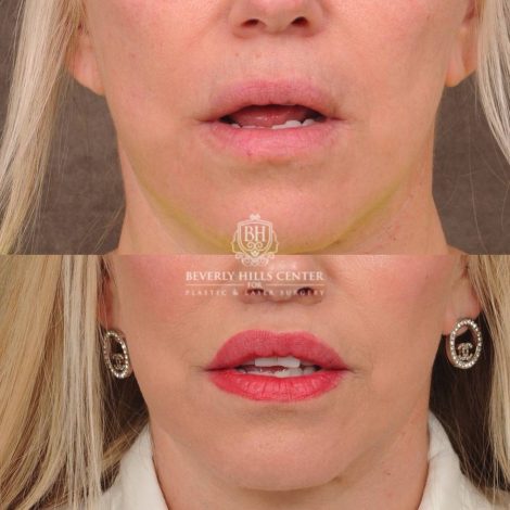 Beverly Hills Center Female Patient Before and After CUPID LIFT® Lip Lift