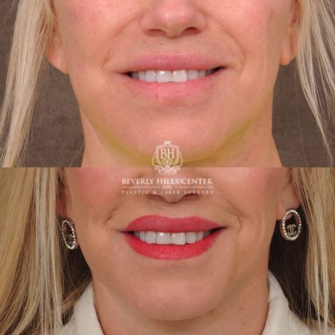 Beverly Hills Center Female Patient Before and After CUPID LIFT® Lip Lift