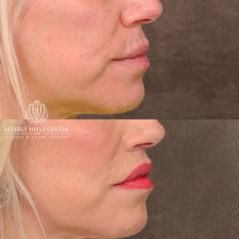 Beverly Hills Center Female Patient Before and After CUPID LIFT® Lip Lift