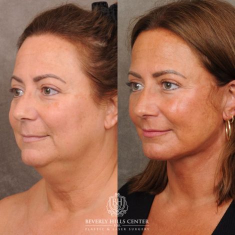Beverly Hills Center Female Patient Before and After AuraLyft