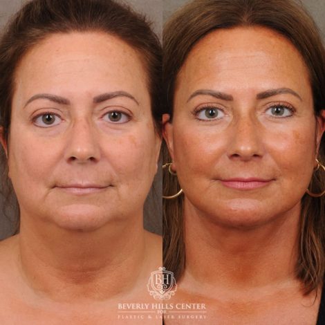 Beverly Hills Center Female Patient Before and After AuraLyft