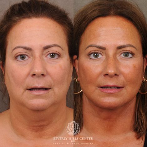 Beverly Hills Center Female Patient Before and After AuraLyft