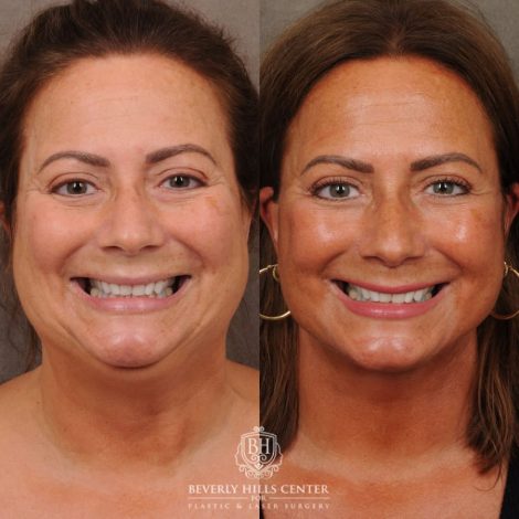 Beverly Hills Center Female Patient Before and After AuraLyft
