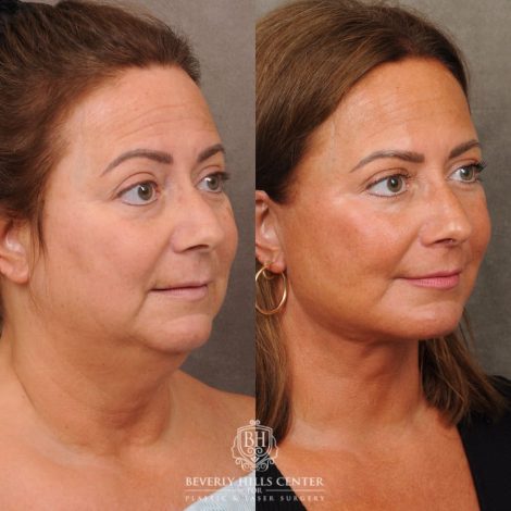 Beverly Hills Center Female Patient Before and After AuraLyft