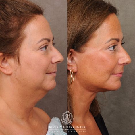 Beverly Hills Center Female Patient Before and After AuraLyft