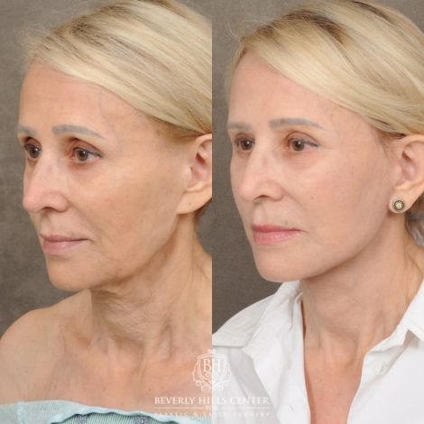 Beverly Hills Center Female Patient Before and After AuraLyft, Upper Blephatorplasty, Ptosis Repair