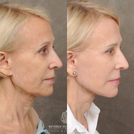 Beverly Hills Center Female Patient Before and After AuraLyft, Upper Blephatorplasty, Ptosis Repair