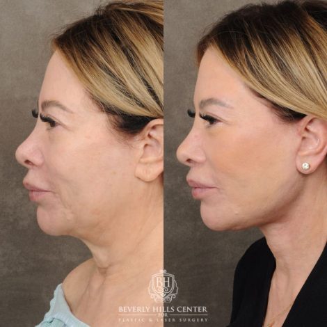 Beverly Hills Center Female Patient Before and After AuraLyft, CUPID LIFT® Corner Lift