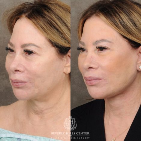 Beverly Hills Center Female Patient Before and After AuraLyft, CUPID LIFT® Corner Lift