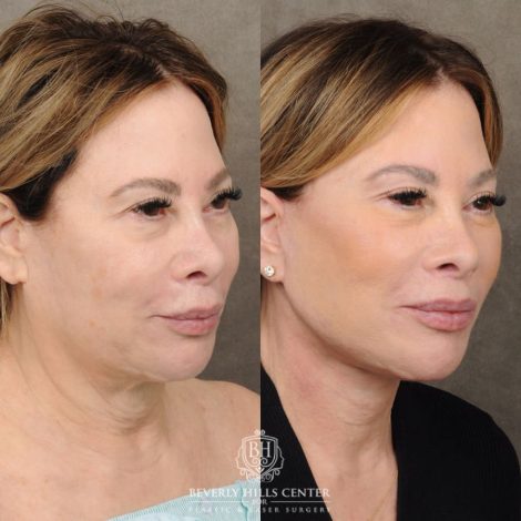 Beverly Hills Center Female Patient Before and After AuraLyft, CUPID LIFT® Corner Lift