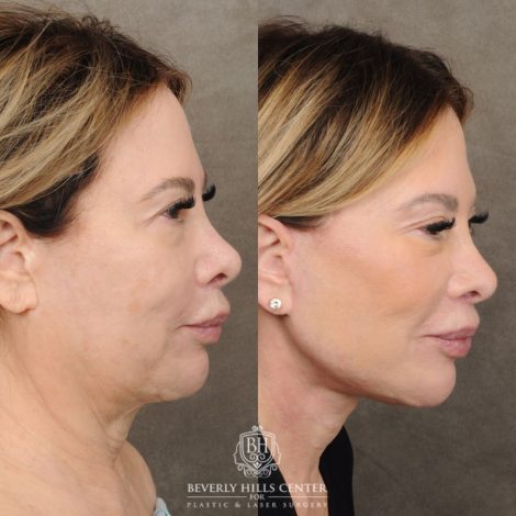 Beverly Hills Center Female Patient Before and After AuraLyft, CUPID LIFT® Corner Lift