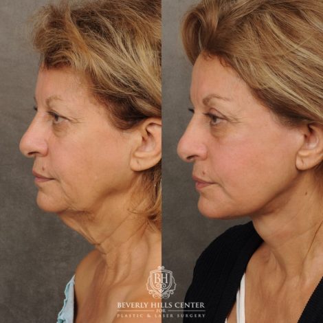 Beverly Hills Center Female Patient Before and After AuraLyft, CUPID LIFT® Corner Lift, Fat Grafting
