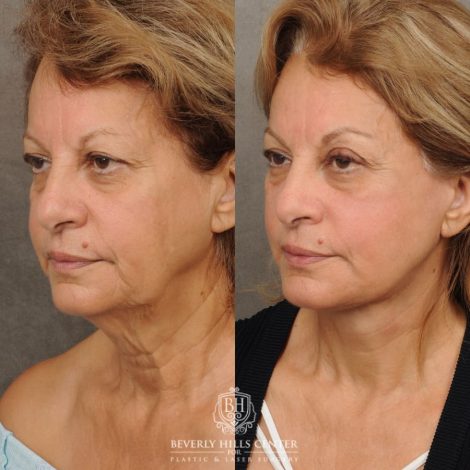 Beverly Hills Center Female Patient Before and After AuraLyft, CUPID LIFT® Corner Lift, Fat Grafting
