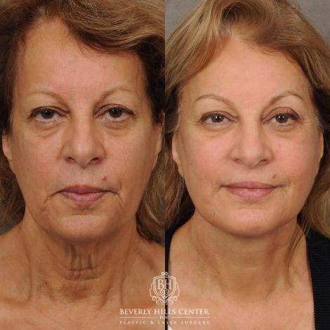 Beverly Hills Center Female Patient Before and After AuraLyft, CUPID LIFT® Corner Lift, Fat Grafting