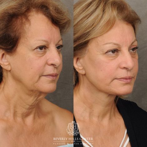 Beverly Hills Center Female Patient Before and After AuraLyft, CUPID LIFT® Corner Lift, Fat Grafting