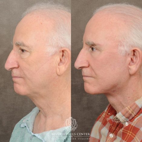 Beverly Hills Center Female Patient Before and After AuraLyft, Brow Lift, Upper & Lower Blepharoplasty