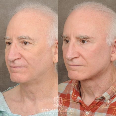 Beverly Hills Center Female Patient Before and After AuraLyft, Brow Lift, Upper & Lower Blepharoplasty