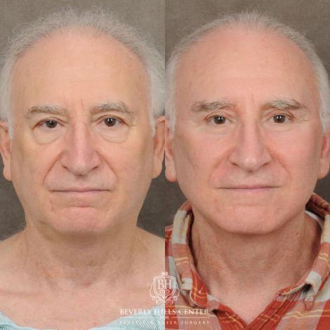 Beverly Hills Center Female Patient Before and After AuraLyft, Brow Lift, Upper & Lower Blepharoplasty