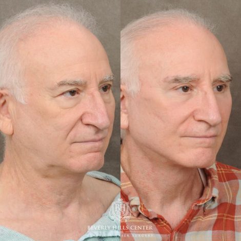 Beverly Hills Center Female Patient Before and After AuraLyft, Brow Lift, Upper & Lower Blepharoplasty