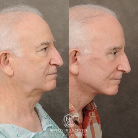 Beverly Hills Center Female Patient Before and After AuraLyft, Brow Lift, Upper & Lower Blepharoplasty