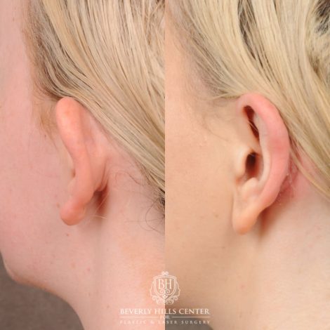 Beverly Hills Center Female Patient Before and After Otoplasty