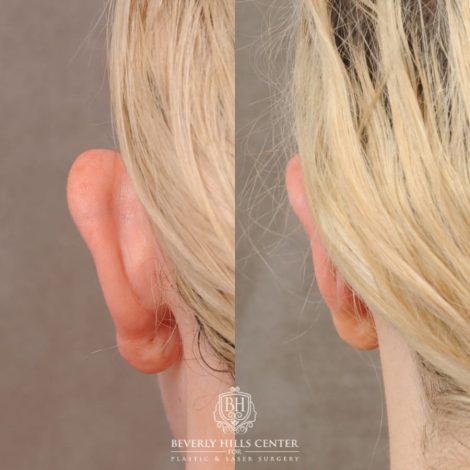 Beverly Hills Center Female Patient Before and After Otoplasty