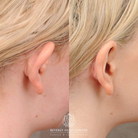 Beverly Hills Center Female Patient Before and After Otoplasty