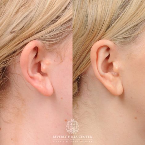 Beverly Hills Center Female Patient Before and After Otoplasty