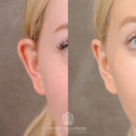 Beverly Hills Center Female Patient Before and After Otoplasty