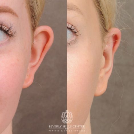 Beverly Hills Center Female Patient Before and After Otoplasty