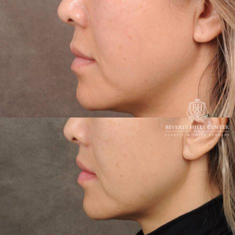 Beverly Hills Center Female Patient Before and After CUPID LIFT® Corner Lift