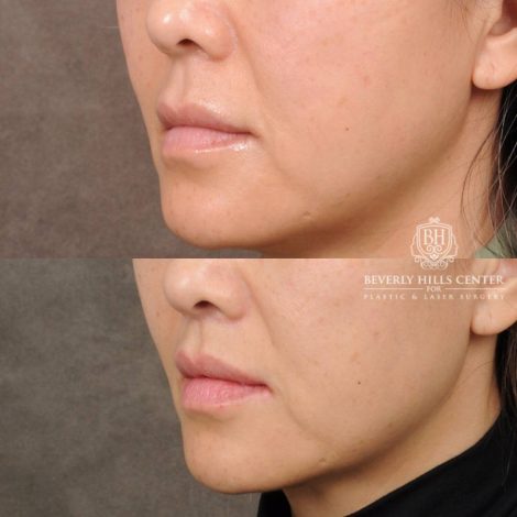 Beverly Hills Center Female Patient Before and After CUPID LIFT® Corner Lift