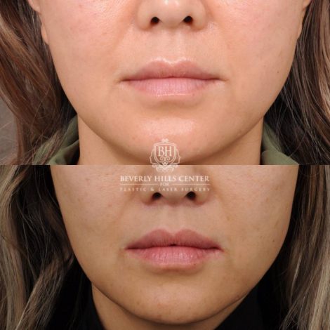 Beverly Hills Center Female Patient Before and After CUPID LIFT® Corner Lift