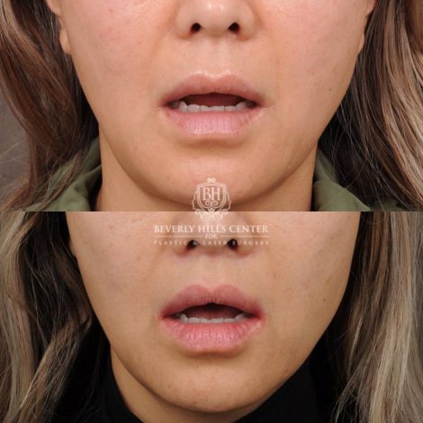 Beverly Hills Center Female Patient Before and After CUPID LIFT® Corner Lift