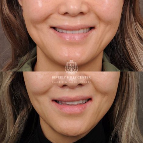 Beverly Hills Center Female Patient Before and After CUPID LIFT® Corner Lift
