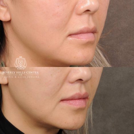 Beverly Hills Center Female Patient Before and After CUPID LIFT® Corner Lift